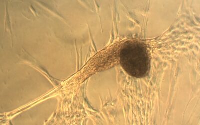 INVESTIGACIÓN DE ALTO NIVEL EN EL DÉFICIT DE FACTOR V